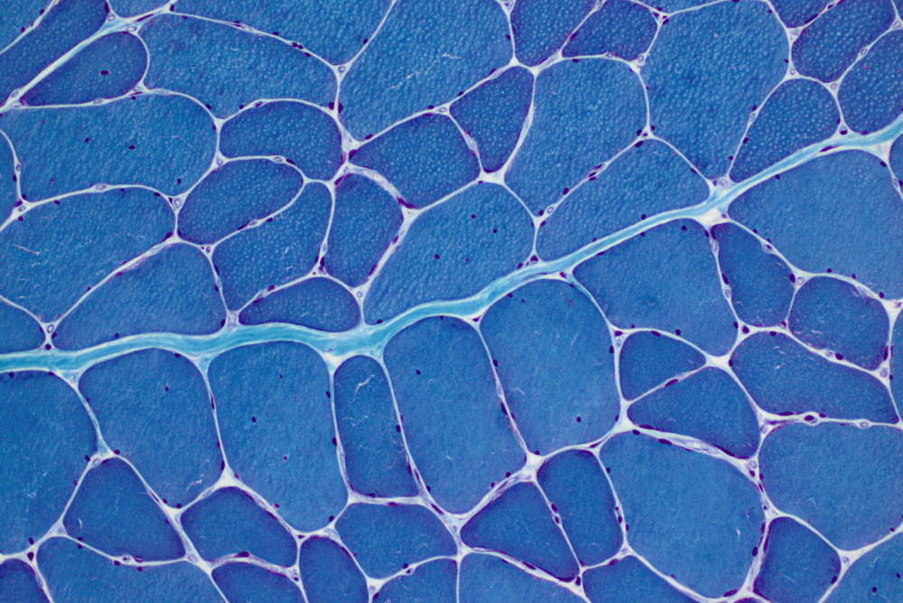 Stained muscle section of a DM1 patient